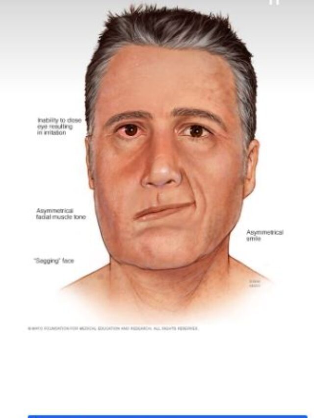 What is Ramsay Hunt Syndrome?